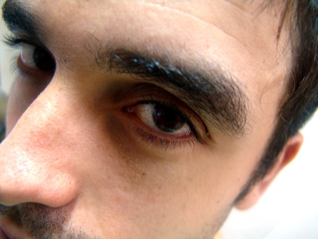 Dunkle Augenringe